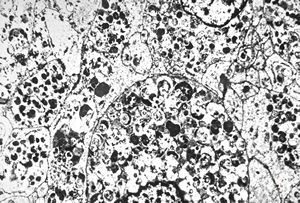 M, 38y. | granular cell tumor M, 38y. | granular cell tumor